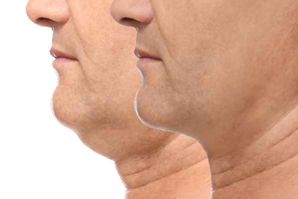 HIFU - Breakthrough in Anti - ageing 2 hifu results Belper