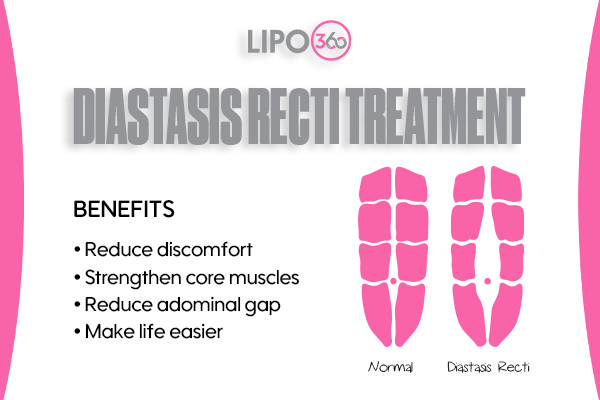 Revolutionising Muscle Repair: The Power of LIPO360 Body Sculpt Post-Injury 5 diastasis recti treatment Belper