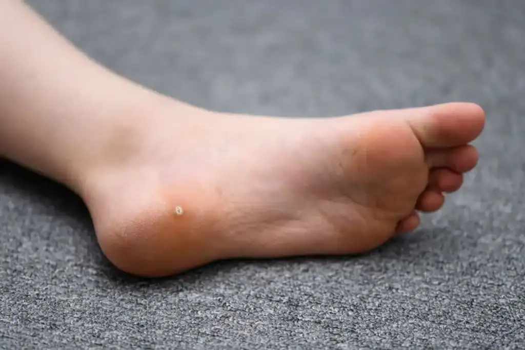 Cryotherapy For Warts And Also Verrucas 2 Image of verruca on the bottom of the foot that able to be treated with Cryotherapy Belper