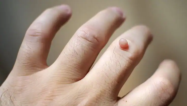 Image of blemish that Cryotherapy Belper can remove with Lipo 360.