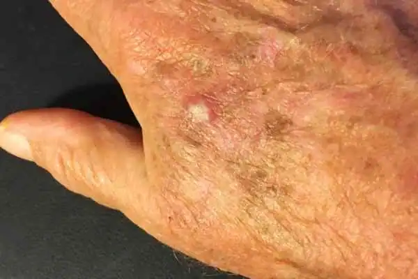 Image of Actinic keratoses Belper on a person hand