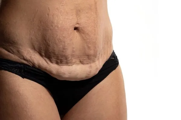 The science behind skin tightening Belper picture of a woman's sagging skin on the stomach